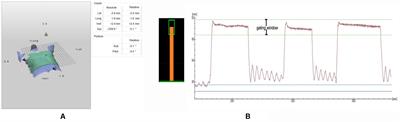 Dosimetry and Feasibility Studies of Volumetric Modulated Arc Therapy With Deep Inspiration Breath-Hold Using Optical Surface Management System for <mark class="highlighted">Left-Sided Breast</mark> Cancer Patients